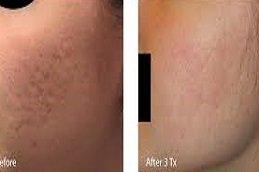 Radiofrequency for Acne Scars in Riyadh and Saudi Arabia