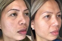 Radiofrequency for Acne Scars in Riyadh and Saudi Arabia