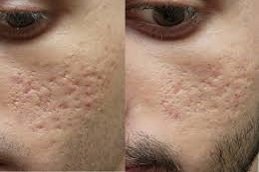 Radiofrequency for Acne Scars in Riyadh and Saudi Arabia