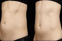 sculpsure body contouring in Riyadh & Saudi Arabia