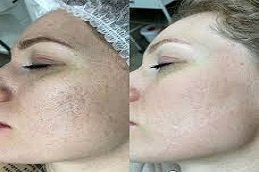 Spectra Laser Carbon Peel in Riyadh & Saudi Arabia