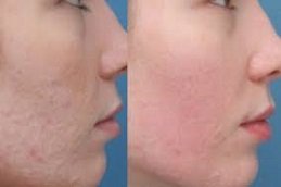 Spectra Laser Carbon Peel in Riyadh & Saudi Arabia