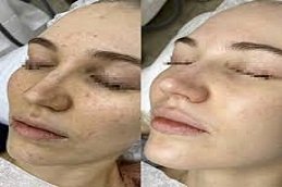 Spectra Laser Carbon Peel in Riyadh & Saudi Arabia