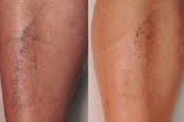 Spider Veins Treatment in Riyadh & Saudi Arabia