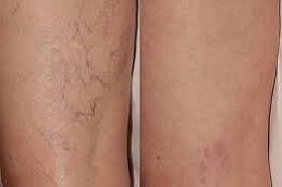 Spider Veins Treatment in Riyadh & Saudi Arabia