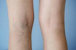 Spider Veins Treatment in Riyadh & Saudi Arabia