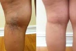 Spider Veins Treatment in Riyadh & Saudi Arabia