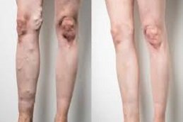 Varicose Veins Treatment in Riyadh & Saudi Arabia