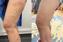 Varicose Veins Treatment in Riyadh & Saudi Arabia