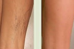 Varicose Veins Treatment in Riyadh & Saudi Arabia