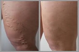 Varicose Veins Treatment in Riyadh & Saudi Arabia