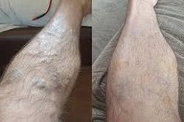 Varicose Veins Treatment in Riyadh & Saudi Arabia