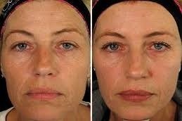 Fractional Laser with PRP therapy