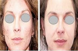 Redermalization Treatment in Riyadh and Saudi Arabia