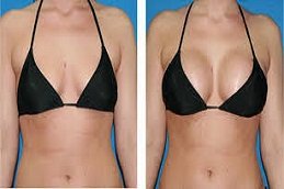 Breast Implants in Riyadh and Saudi Arabia