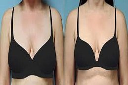 Breast Lift Surgery in Riyadh and Saudi Arabia