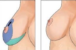 Breast Reduction In Riyadh & Saudi Arabia