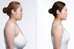 Breast Reduction In Riyadh & Saudi Arabia