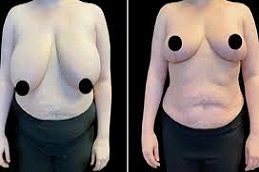 Breast Reduction In Riyadh & Saudi Arabia