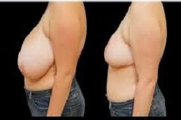 Breast Reduction In Riyadh & Saudi Arabia