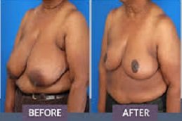 Breast Reduction In Riyadh & Saudi Arabia