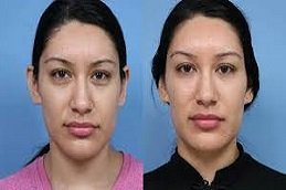 Cosmetic Injectables in Riyadh & Saudi Arabia