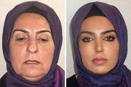 cosmetic surgery in Riyadh & Saudi Arabia