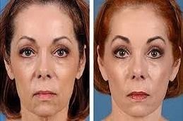 cosmetic surgery in Riyadh & Saudi Arabia