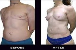 DIEP Flap Breast Reconstruction in Riyadh & Saudi Arabia