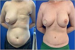 DIEP Flap Breast Reconstruction in Riyadh & Saudi Arabia