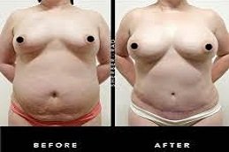 DIEP Flap Breast Reconstruction in Riyadh & Saudi Arabia