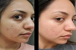 Dry Skin Treatment in Riyadh & Saudi Arabia