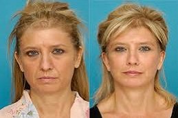 Face Rejuvenation Treatment in Riyadh & Saudi Arabia