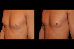 Inverted Nipple Surgery in Riyadh & Saudi Arabia