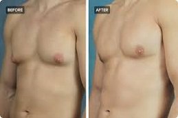 Lipo Chest Surgery in Riyadh & Saudi Arabia