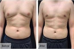 Lipo Chest Surgery in Riyadh & Saudi Arabia