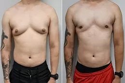 Lipo Chest Surgery in Riyadh & Saudi Arabia