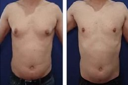 Lipo Chest Surgery in Riyadh & Saudi Arabia