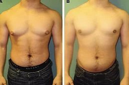 Lipo Chest Surgery in Riyadh & Saudi Arabia