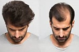 Male Hair Transplant in Riyadh