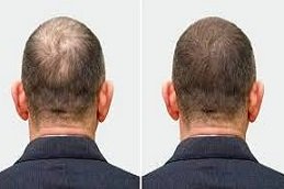 Male Hair Transplant in Riyadh