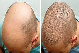 Male Hair Transplant in Riyadh