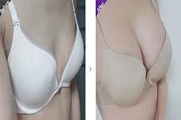 Motiva Breast Implant in Riyadh and Saudi Arabia