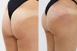 Non-Surgical Bum Lift in Riyadh & Saudi Arabia