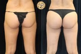 Non-Surgical Bum Lift in Riyadh & Saudi Arabia