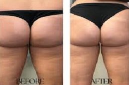 Non-Surgical Bum Lift in Riyadh & Saudi Arabia