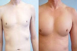 Pectoral Implants in Riyadh & Saudi Arabia