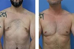 Pectoral Implants in Riyadh & Saudi Arabia