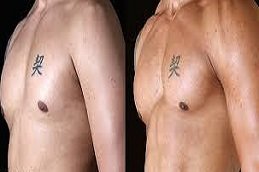 Pectoral Implants in Riyadh & Saudi Arabia