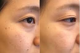 Pigmentation Treatment in Riyadh & Saudi Arabia at Aesthetic Clinic